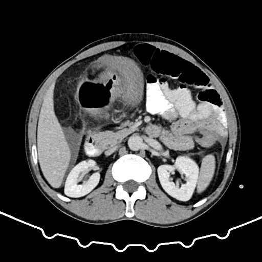 Colocolic intussusception due to large lipoma (Radiopaedia 68773-78482 A 67).jpg