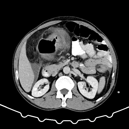 File:Colocolic intussusception due to large lipoma (Radiopaedia 68773-78482 A 68).jpg