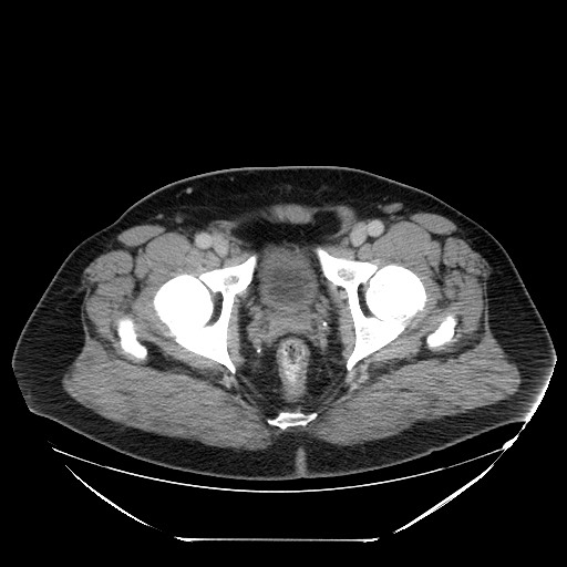 File:Colocolic intussusception due to lipoma (Radiopaedia 73712-84508 Axial 111).jpg