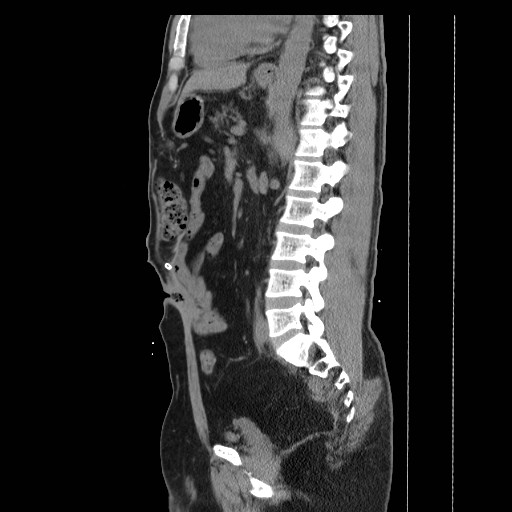 File:Colocutaneous fistula in Crohn's disease (Radiopaedia 29586-30093 C 30).jpg