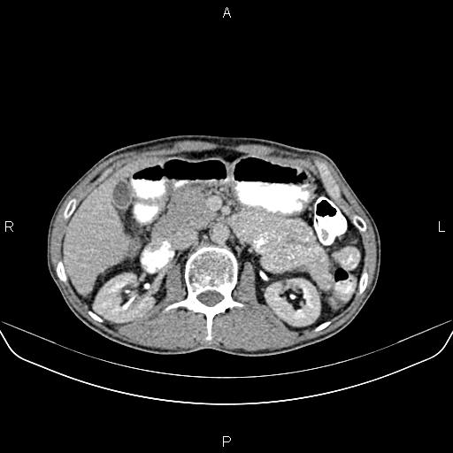 File:Colon adenocarcinoma - hepatic flexure (Radiopaedia 85635-101395 Axial C+ delayed 34).jpg