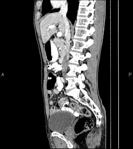 Colon adenocarcinoma - hepatic flexure (Radiopaedia 85635-101395 D 39).jpg