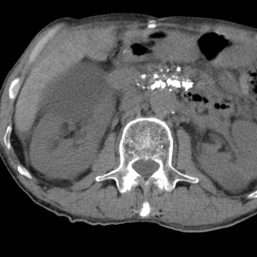 Colon cancer with calcified liver metastasis (Radiopaedia 74423-85309 Axial non-contrast 39).jpg