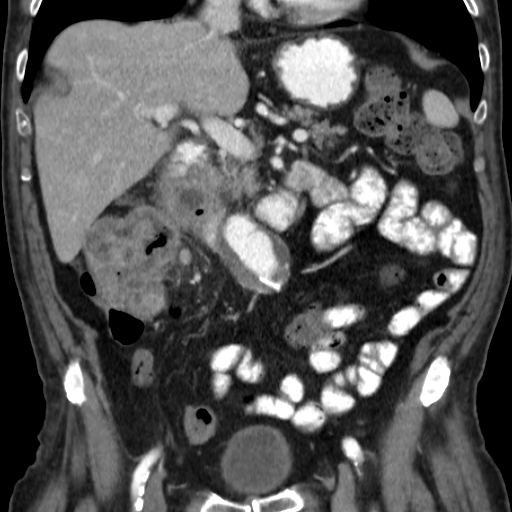 File:Colon cancer with duodenal invasion (Radiopaedia 16278-15958 B 27).jpg