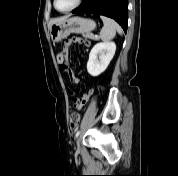 Colon carcinoma with hepatic metastases (Radiopaedia 29477-29961 C 41).jpg