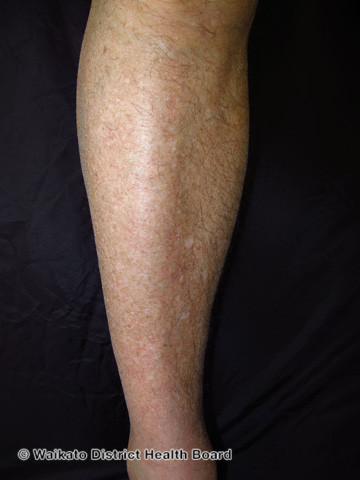 File:Ichthyosis vulgaris (DermNet NZ scaly-w-ichthyosis-vulgaris-2).jpg