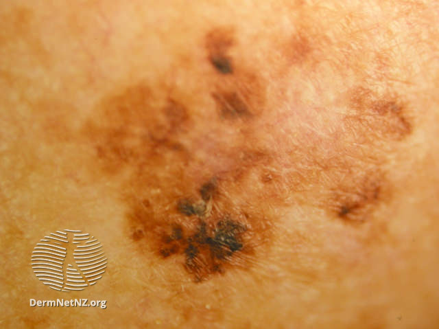 File:Melanoma in situ (DermNet NZ melanoma-abcd-13).jpg