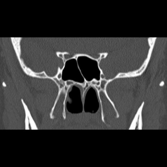 Nasal septal perforation (Radiopaedia 25030-25289 Coronal bone window 54).jpg