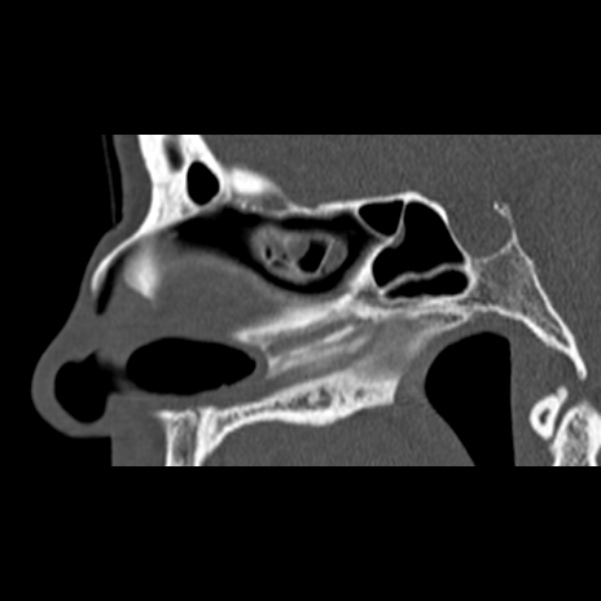 Nasal septal perforation (Radiopaedia 25030-25289 Sagittal bone window 30).jpg