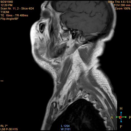 File:Nasopharyngeal carcinoma (Radiopaedia 22375-22403 Sagittal T1 C+ 2).jpg