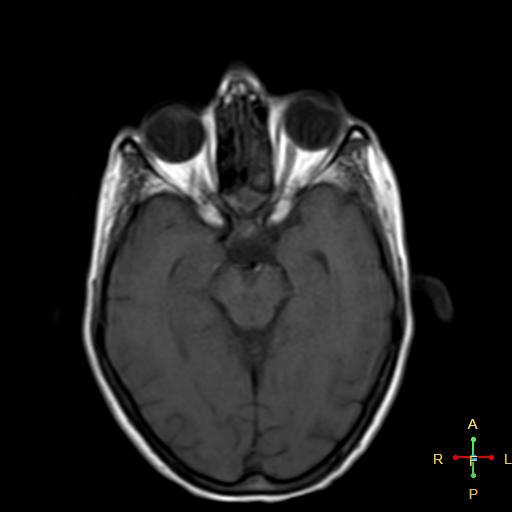 File:Nasopharyngeal carcinoma infiltrating the clivus (Radiopaedia 25229-25481 Axial T1 8).jpg