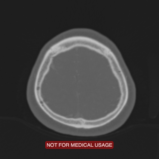 File:Nasopharyngeal carcinoma recurrence - skull base destruction (Radiopaedia 29107-29490 Axial bone window 18).jpg