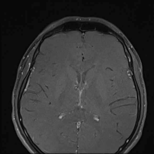 File:Nasopharyngeal carcinoma with skull base invasion (Radiopaedia 53415-59485 Axial T1 C+ fat sat 6).jpg