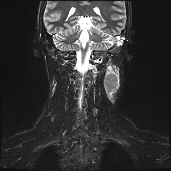 Nasopharyngeal carcinoma with skull base invasion (Radiopaedia 53415-59485 Coronal T2 fat sat 6).jpg