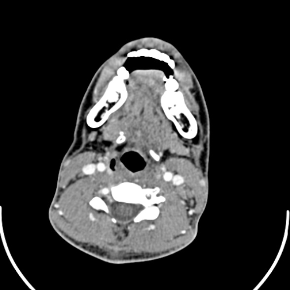 File:Nasopharyngeal carcinoma with skull base invasion (Radiopaedia 53415-59705 A 126).jpg