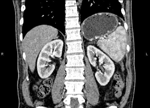 Necrotizing pancreatitis (Radiopaedia 87796-104248 F 48).jpg