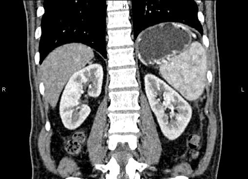 Necrotizing pancreatitis (Radiopaedia 87796-104248 F 50).jpg