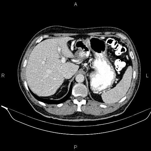 Necrotizing pancreatitis (Radiopaedia 87796-104249 A 15).jpg