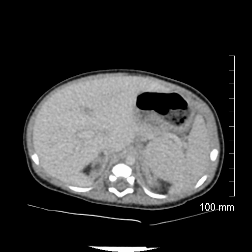 File:Neonatal neuroblastoma (Radiopaedia 56651-63438 Axial non-contrast 25).jpg