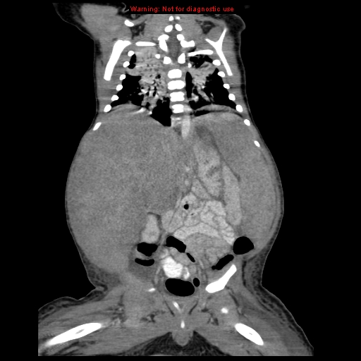 File:Neonatal neuroblastoma (Radiopaedia 9564-10223 B 80).jpg
