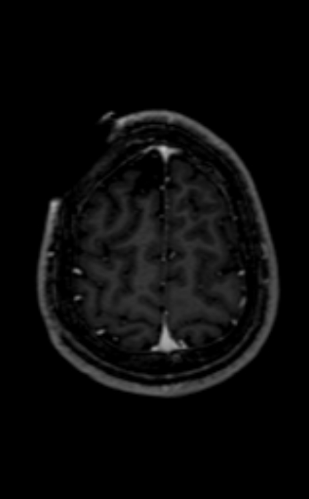 Neuro-Behçet disease (Radiopaedia 90112-107294 Axial T1 C+ 68).jpg