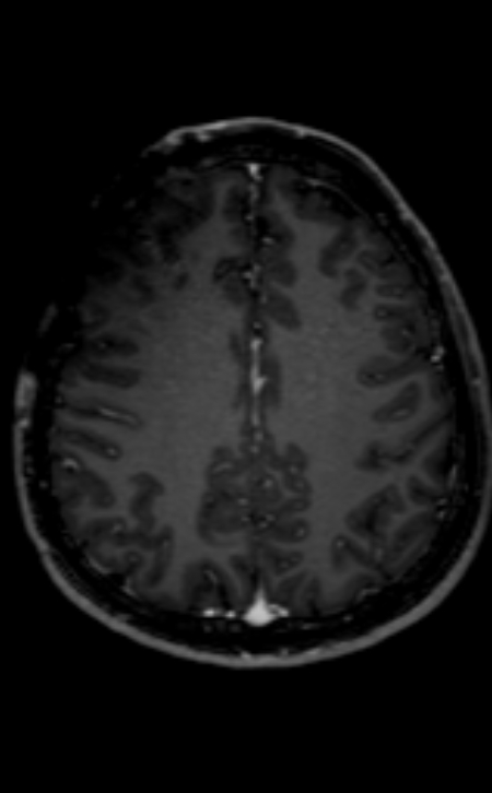 Neuro-Behçet disease (Radiopaedia 90112-107294 Axial T1 C+ 94).jpg