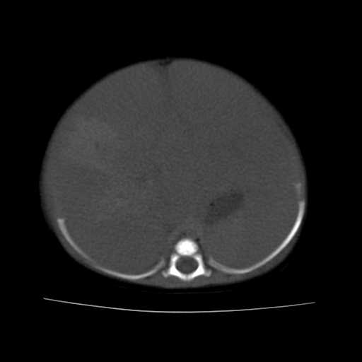 File:Neuroblastoma (Radiopaedia 20876-20799 Axial non-contrast 7).jpg