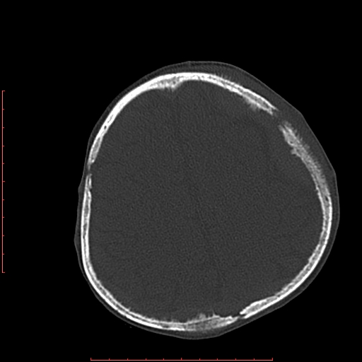 File:Neuroblastoma skull metastasis (Radiopaedia 56053-62683 Axial bone window 20).jpg