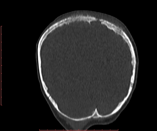 File:Neuroblastoma skull metastasis (Radiopaedia 56053-62683 Coronal bone window 36).jpg