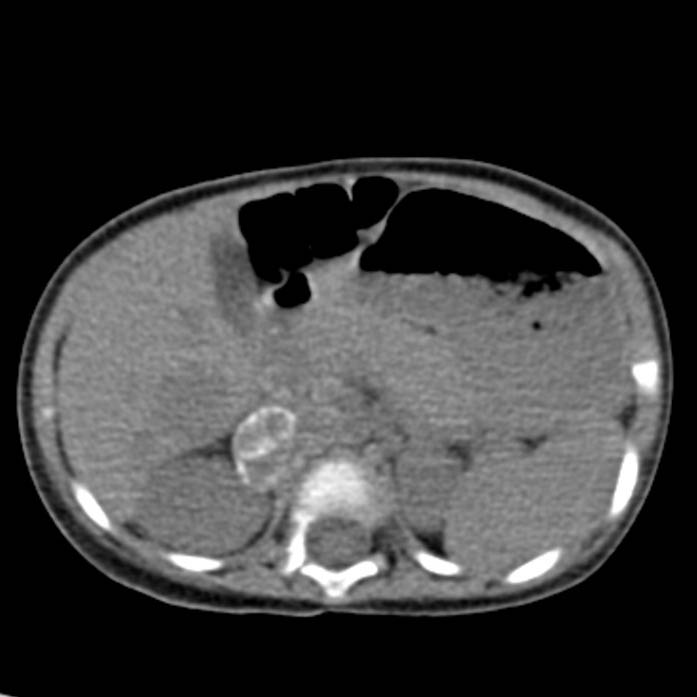 Neuroblastoma with skull metastases (Radiopaedia 30326-30960 Axial non-contrast 20).jpg