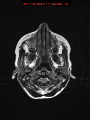 File:Neurofibromatosis type 1 with optic nerve glioma (Radiopaedia 16288-15965 Axial FLAIR 24).jpg