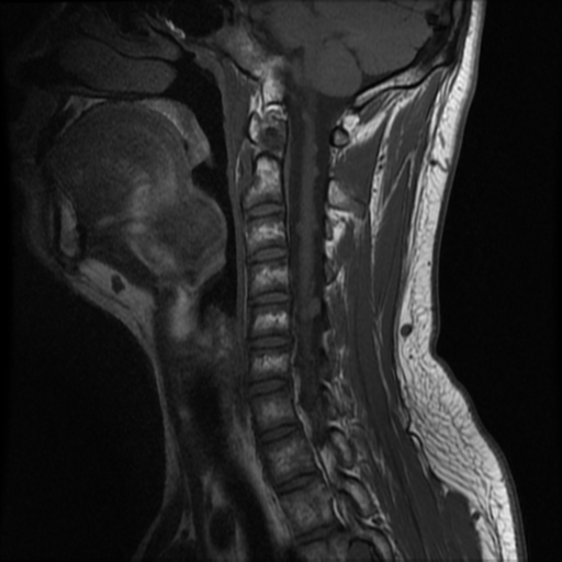 File:Neurofibromatosis type 2 (Radiopaedia 44936-48837 Sagittal T1 10).png