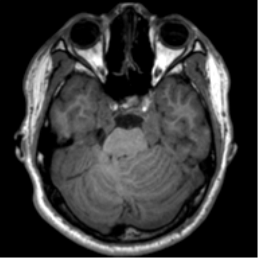 File:Neurofibromatosis type 2 (Radiopaedia 44936-48838 Axial T1 38).png