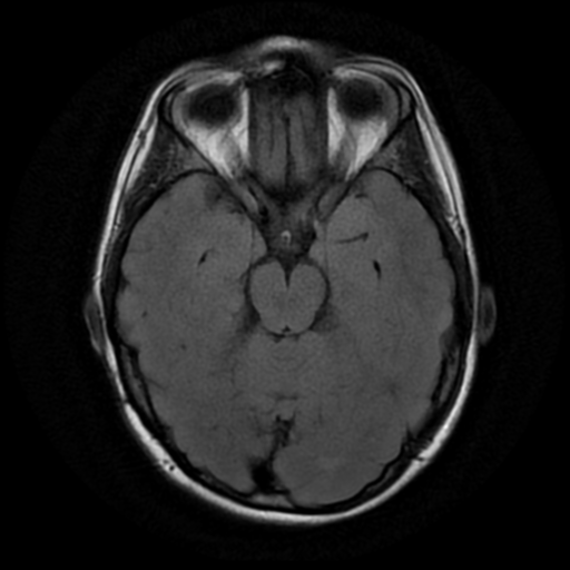 File:Neurofibromatosis type 2 (Radiopaedia 45229-49244 Axial FLAIR 7).png
