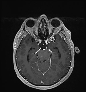 Neurofibromatosis type 2 (Radiopaedia 79097-92049 Axial T1 C+ 82).jpg