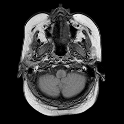 File:Neurofibromatosis type 2 (Radiopaedia 8713-9518 Axial T1 22).jpg