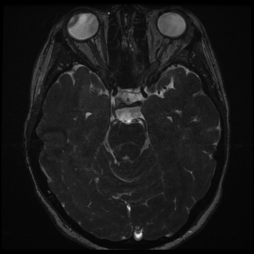 File:Neurofibromatosis type 2 - bilateral acoustic neuromata (Radiopaedia 40060-42566 Axial FIESTA 74).png