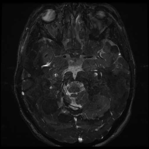 Neurofibromatosis type 2 - bilateral acoustic neuromata (Radiopaedia 40060-42566 Axial FIESTA 84).png
