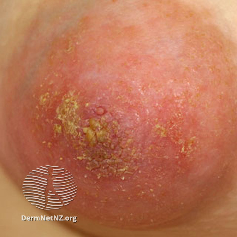File:Nipple eczema (DermNet NZ dermatitis-s-atopic29).jpg