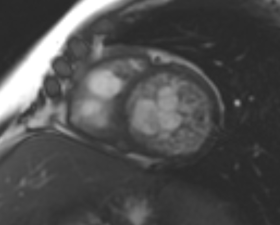 File:Non-compaction of the left ventricle (Radiopaedia 69436-79314 Short axis cine 111).jpg
