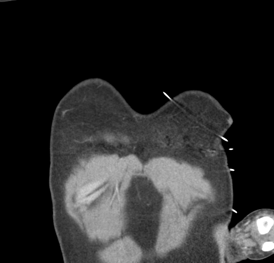 File:Normal CTA thorax (non ECG gated) (Radiopaedia 41750-44704 B 8).png