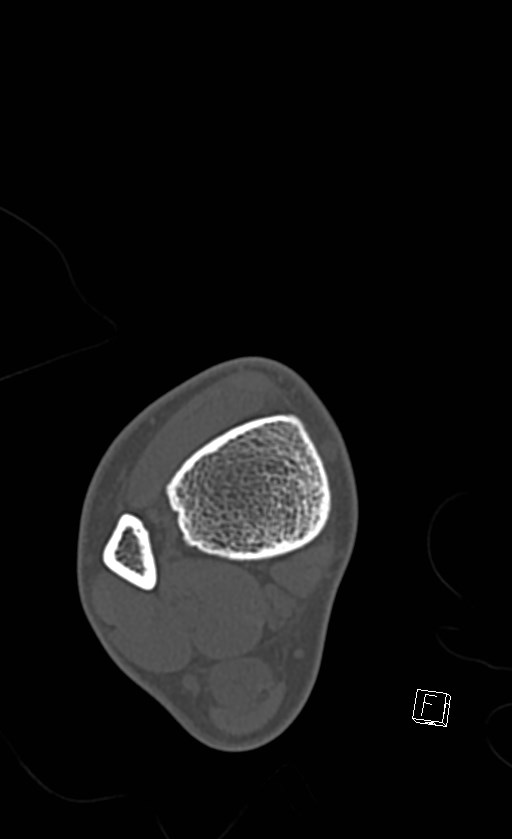 Normal CT of the ankle (Radiopaedia 47111-51658 Axial bone window 18).jpg