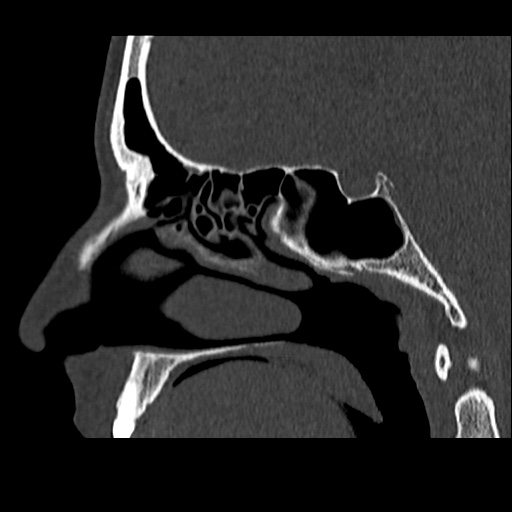 Normal CT paranasal sinuses (Radiopaedia 42286-45390 Sagittal bone window 46).jpg