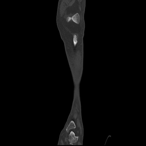 Normal CT tibia and fibula (Radiopaedia 51195-56848 Coronal non-contrast 22).jpg