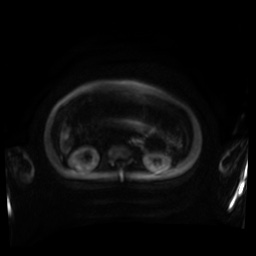 Normal MRI abdomen in pregnancy (Radiopaedia 88001-104541 Axial DWI 116).jpg