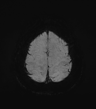 Normal MRI internal auditory canal (Radiopaedia 41613-44525 Axial SWI MIP 70).png