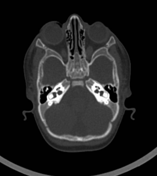 Normal brain CT - 2-month-old (Radiopaedia 53369-59350 Axial bone window 49).jpg