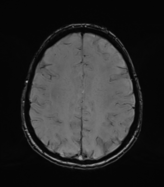 Normal brain MRI (TLE protocol) (Radiopaedia 40748-43405 Axial SWI 61).png
