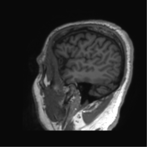 Normal brain MRI (non-focal epilepsy protocol) (Radiopaedia 53917-60040 Sagittal T1 60).png