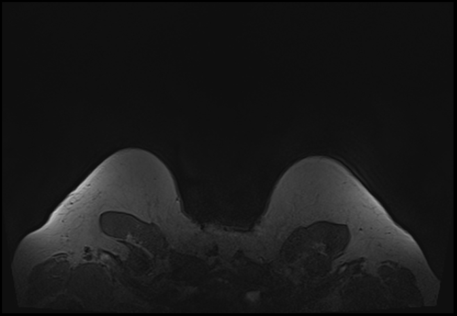 File:Normal breast MRI - dense breasts (Radiopaedia 80454-93850 Axial T1 218).jpg